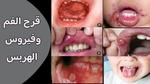 علاج قروح الفم الطبيعية للأطفال
