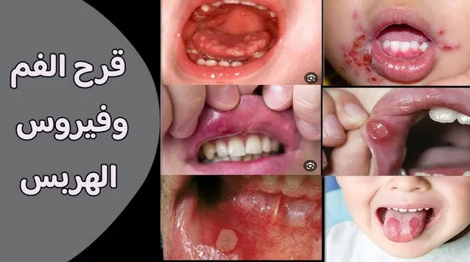علاج قروح الفم الطبيعية للأطفال